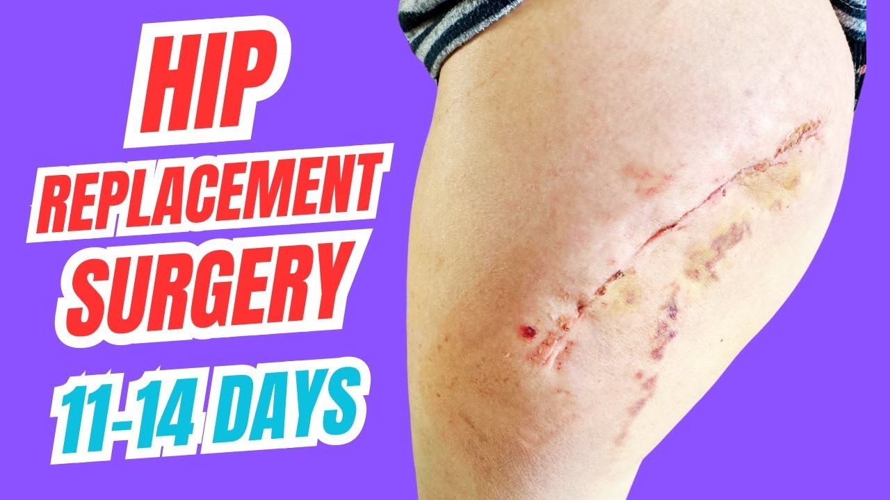 The Honest Truth About Hip Replacement Recovery | Days 6–11 Update