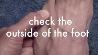 Stress Fracture Self Diagnosis for Runners by San Francisco Running Podiatrist.m4v Metatarsal Stress Fractures How To Diagnose Yourself