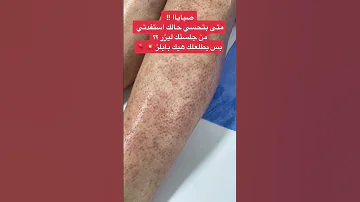 الجسم بعد الليزر Shorts 
