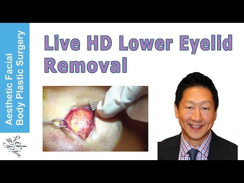 SEE US REMOVE LOWER EYELID FAT IN HD in this live plastic surgery video. INTRO with BRIEF HISTORY