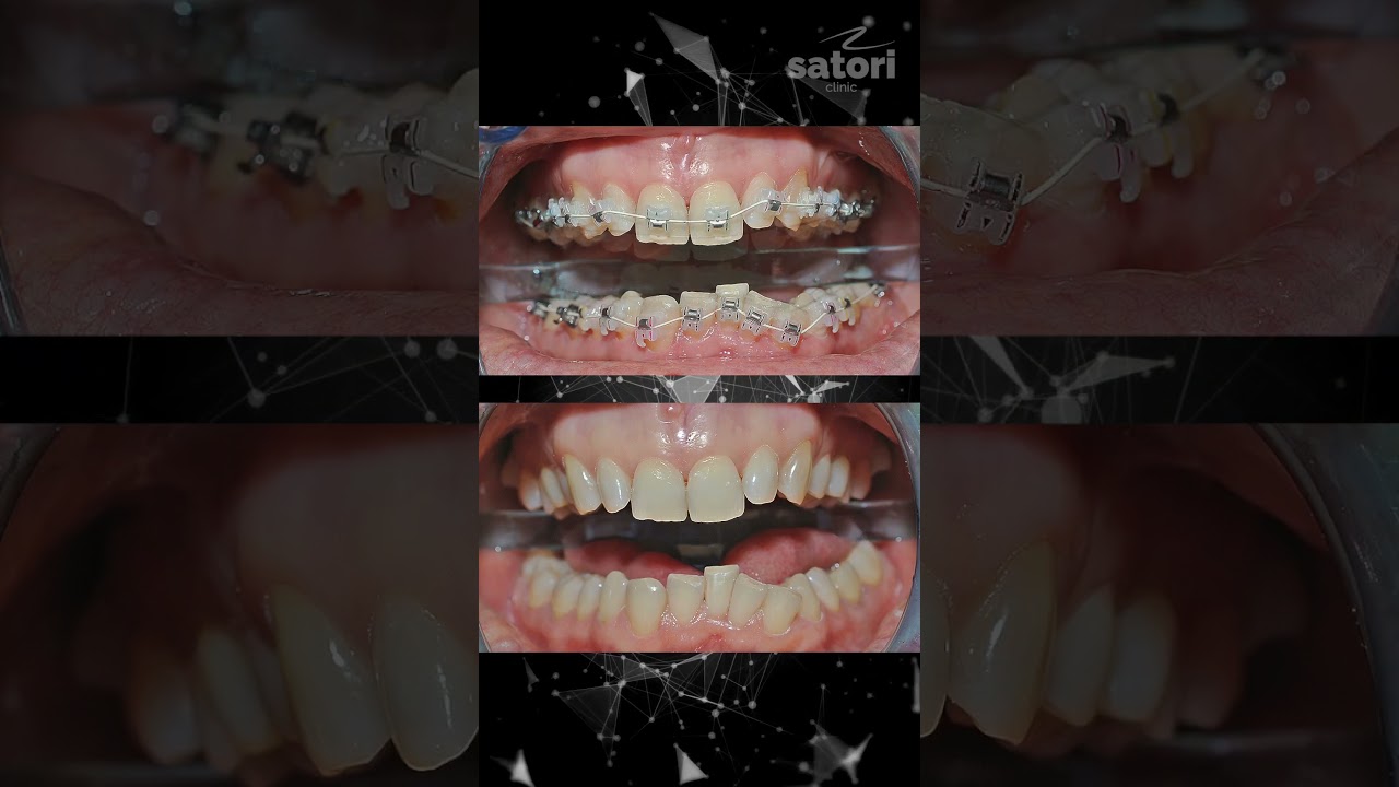 Исправление прикуса керамическими брекетами #брекеты #зубы #braces