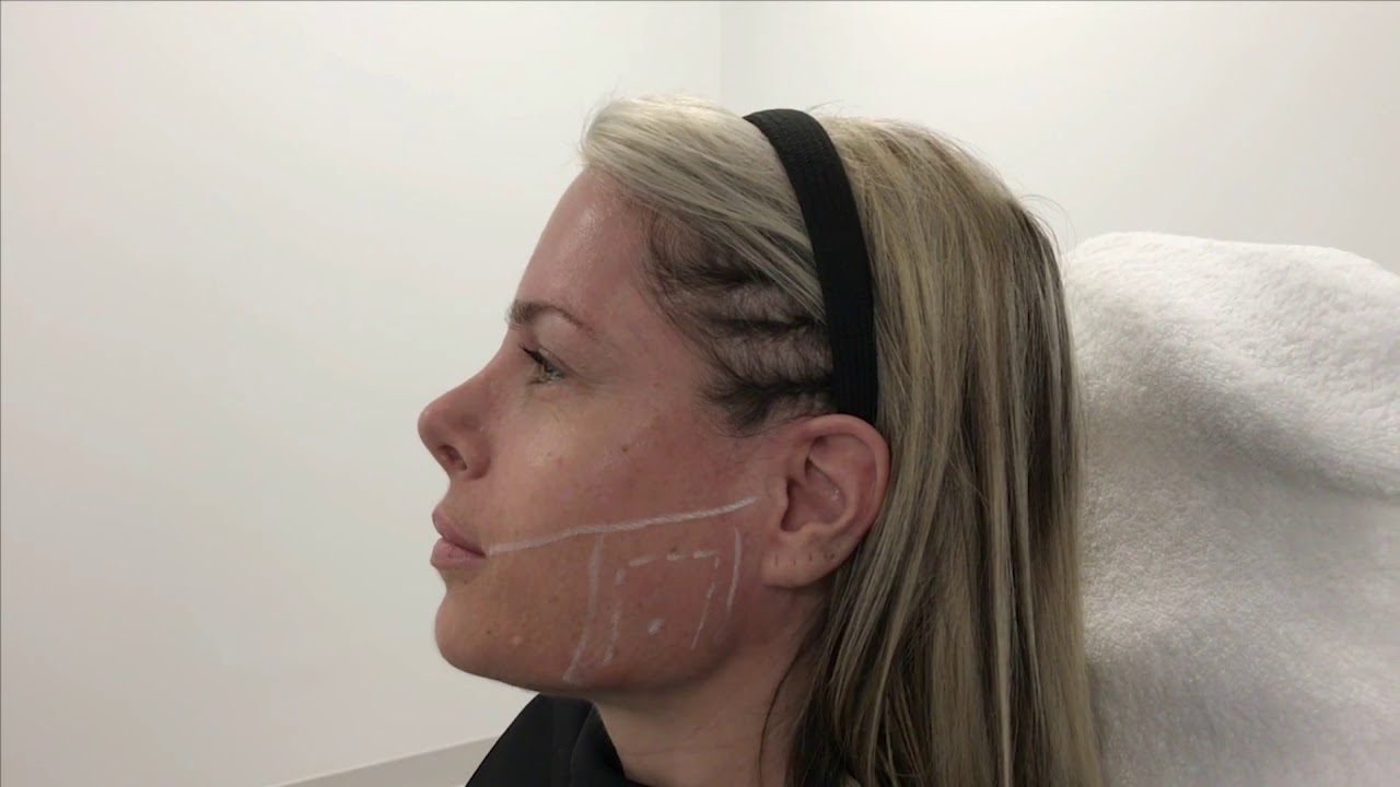Incobotulinumtoxina In The Management Of Masseter Hypertrophy