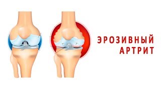 Что такое эрозивный артрит и как он лечится? Что такое эрозивный артрит и как он лечится?