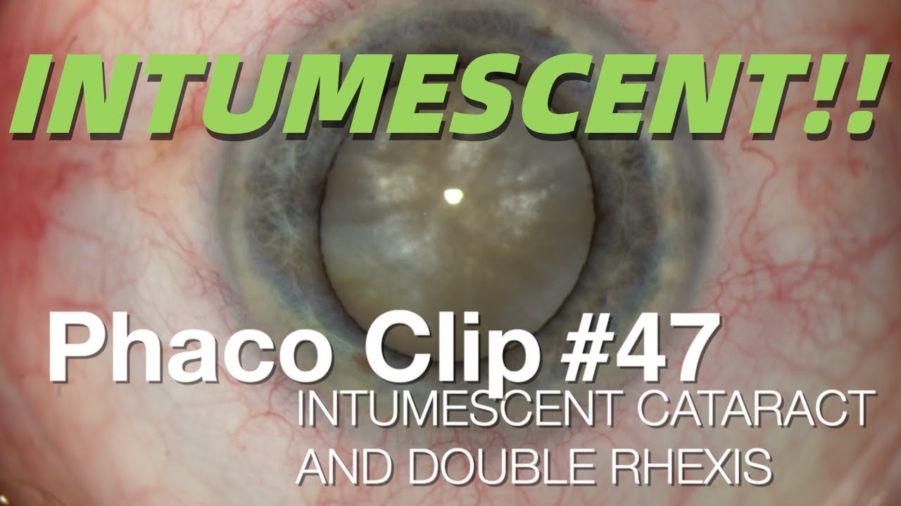 Phaco Clip #47 - Intumescent Cataract & Double Rhexis - YouTube