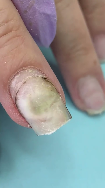 What Happened 🤢After Using Nail Glue