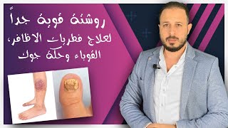 روشتة قوية جدا لفطريات الاظافر ،القوباء وحكة جوك ,Fungal infection,onchomycosis