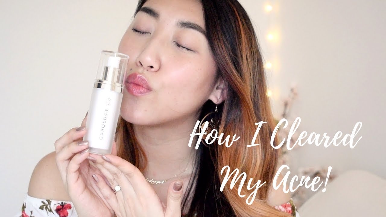 How I Got Rid of My Acne With One Product | My Acne Story + Curology ...