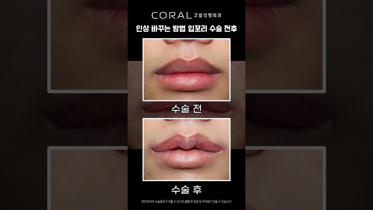 "너 무슨 일 있어?" 소리 듣던 무표정의 미친 변신...B&A 💥 #shorts  #liplift