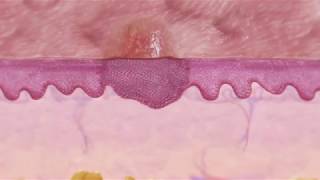 Skin Cancer Squamous Cell Carcinoma