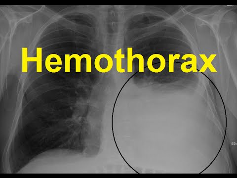 Video: Hemothorax: Symptoms, Treatment, Causes