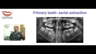 Dr. Rafi Romano- Serial Extraction of primary teeth
