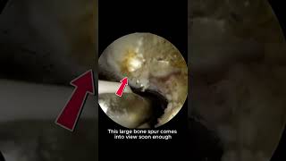 Part 2: Under the Scope — Treating Elbow Arthritis