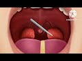 ASMR noes treatment animation | satisfying white tongue &amp; tonsils removal ASMR