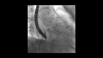 Left atrial appendage closure release for managing thromboembolic risk in atrial fibrillation