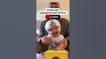 ⁉️нужен ли шлем при деформации черепа