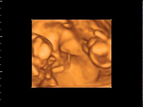 window to the womb bexleyheath 3D 4D Ultrasound baby scan. The Original Window to the Womb Ltd