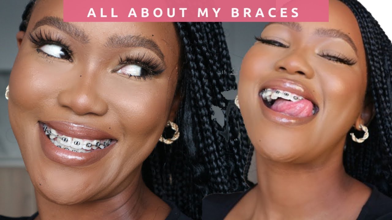 ADULT BRACES My Journey South African YouTuber YouTube ADULT BRACES My Journey South African YouTuber YouTube