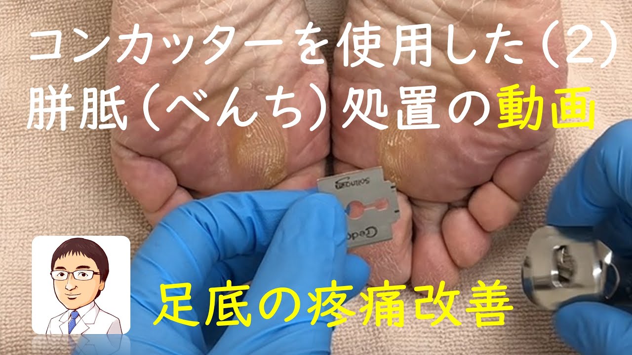 足底胼胝 ベンチ の処置２ コーンカッターで削る 巻き爪 陥入爪治療の相談室 Dolorous Plantar Callus Treatment タコ 魚の目 鶏眼 Youtube