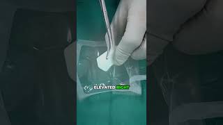 EXPLAINING PARTIAL KNEE REPLACEMENT POLY IMPLANT #drpankajwalecha