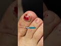 Your TOE needs treatment even if you just banged it accidentally!! 🦶