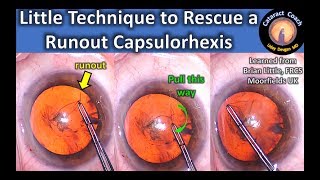 Little Technique to Rescue a Runout Capsulorhexis during Cataract Surgery