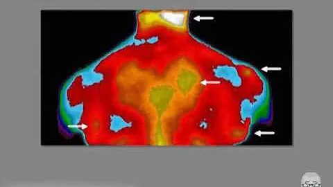 ¿Puede un neurólogo detectar la fibromialgia?