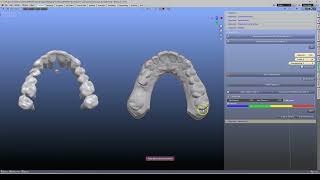 🦷 ICP Alignment – Models to AI Segmentations | Multiple Landmarks
