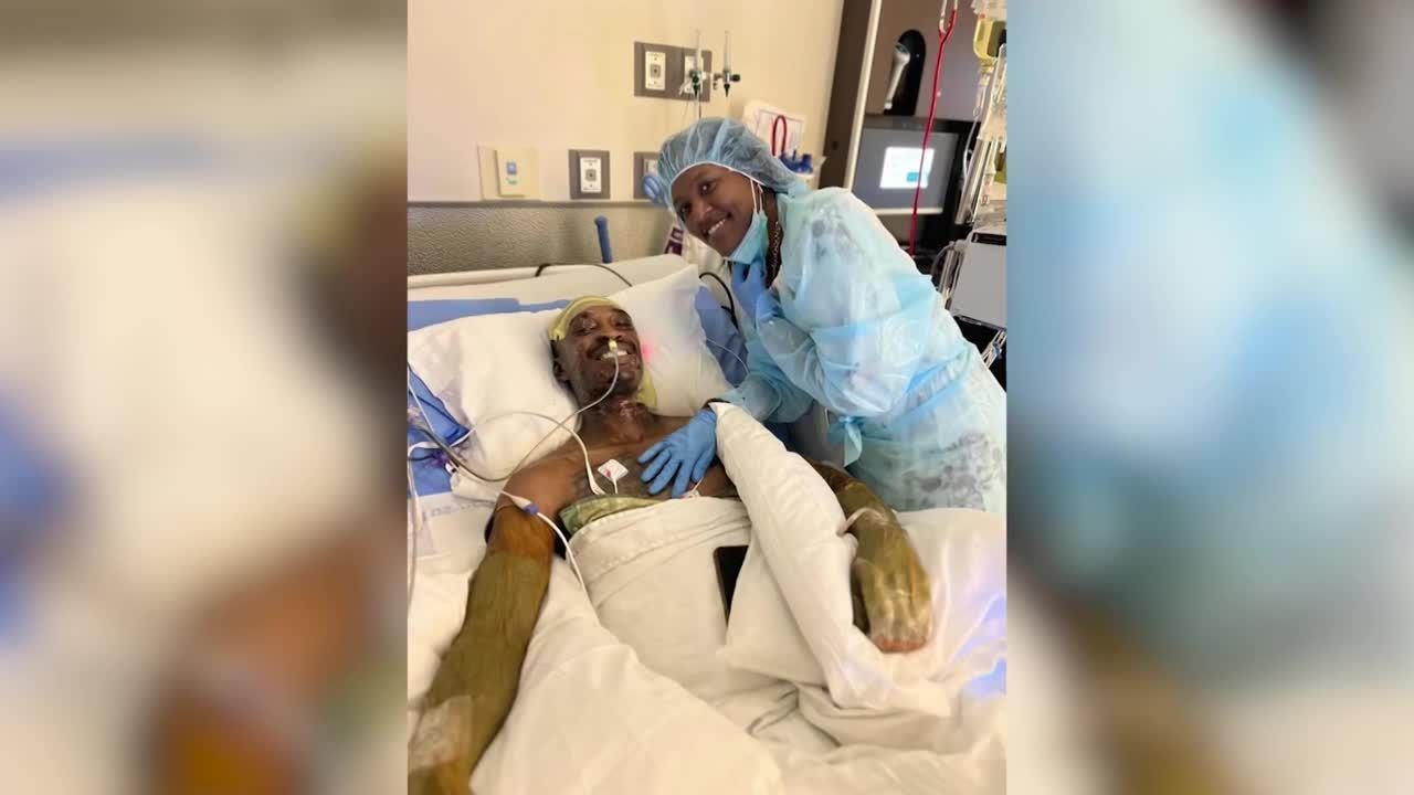 Georgia man looks back 6 months after suffering chemical burns while ...