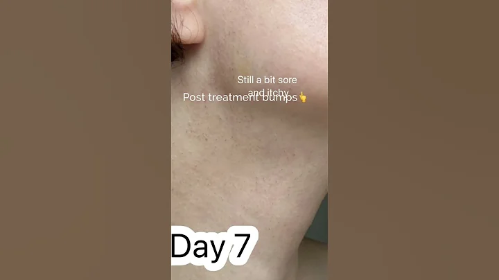 My Morpheus 8 Journey: Day 0-10.      #shorts #beauty #skincaretips #skincare #drsouphi