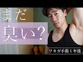 ワキガ切開手術をしてから１年後の傷跡と臭い・・・。 最強ワキガ対策グッズの紹介も！