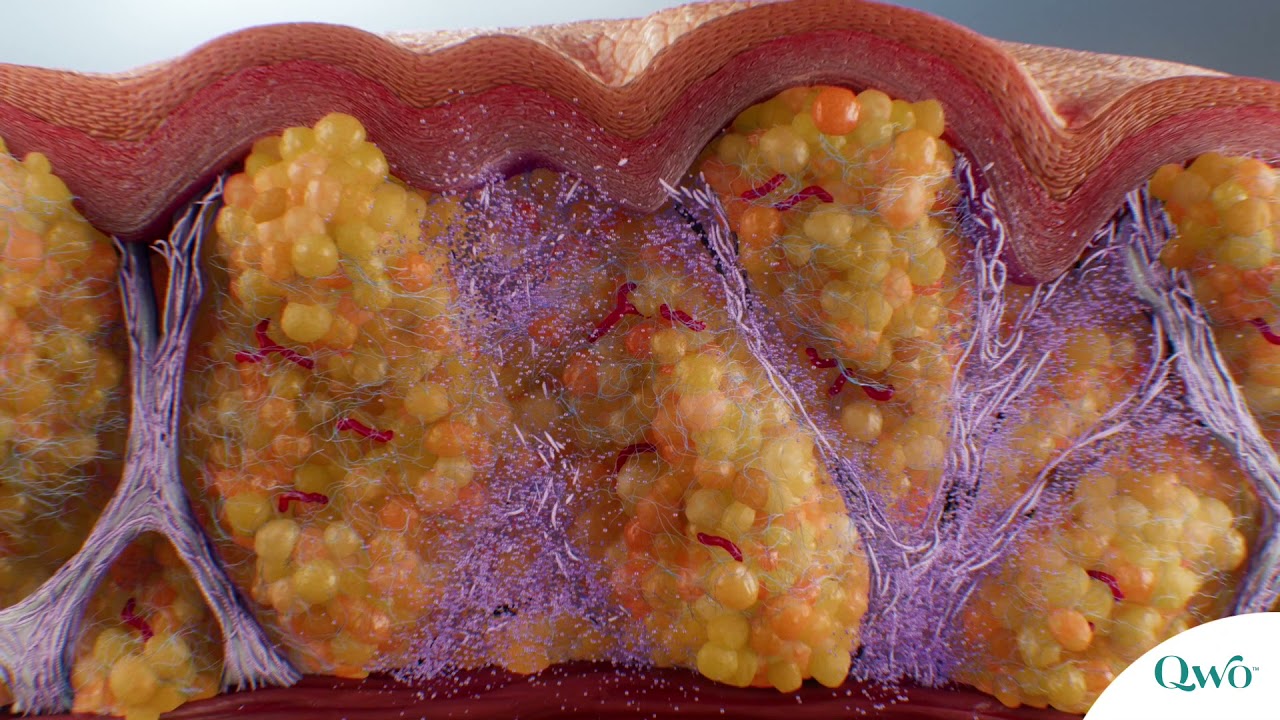 Introducing QWO: A Non-invasive Treatment For Cellulite.