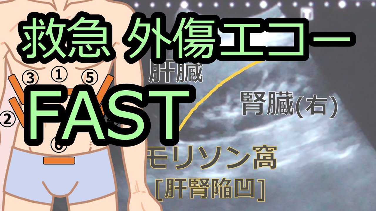 FAST 外傷エコー【看護師、研修医向け】