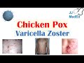 Chickenpox  varicella zoster virus  pathogenesis signs and symptoms diagnosis and treatment