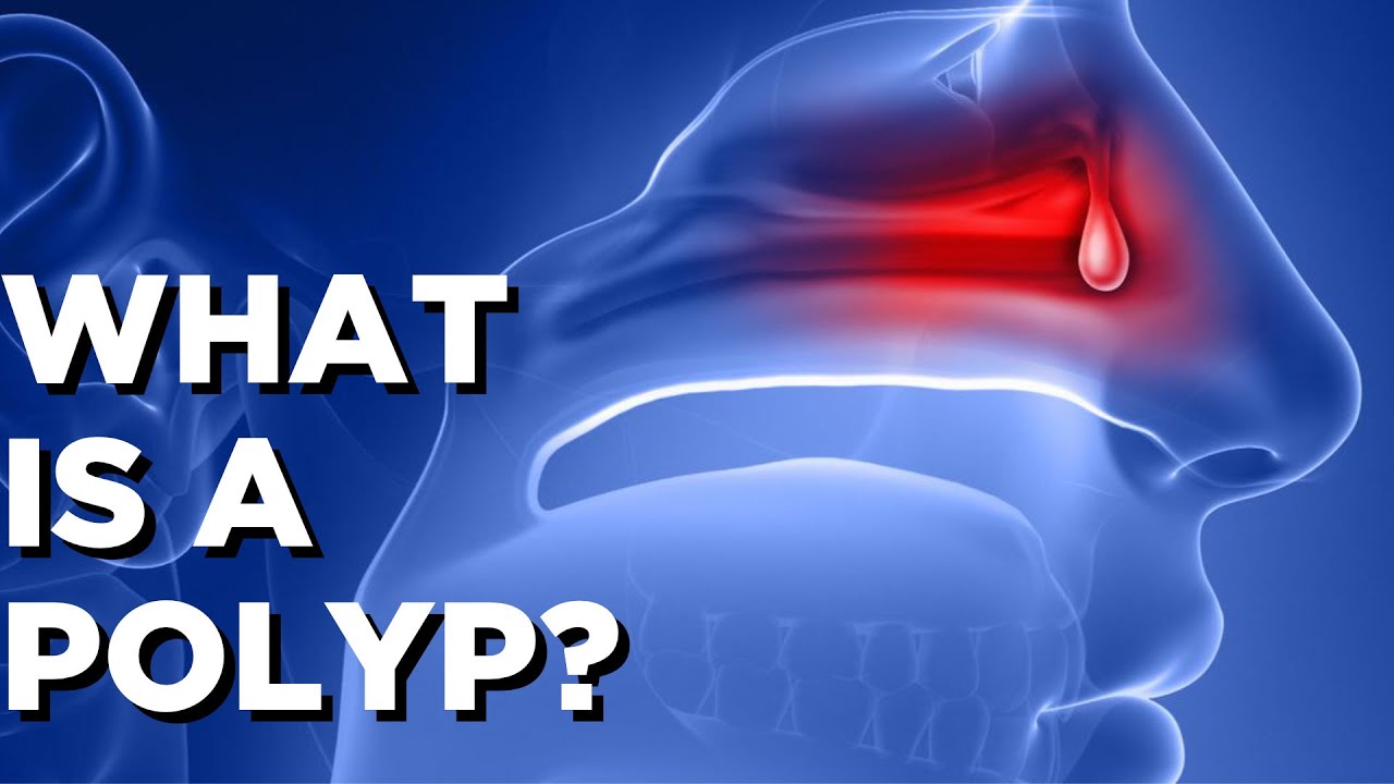 What is a POLYP? Sleep and Sinus Centers of YouTube