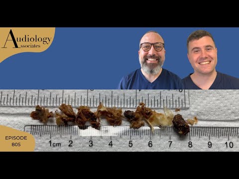 EAR WAX REMOVAL COMPILATION INC MASTOID CAVITY CLEARANCE- EP805