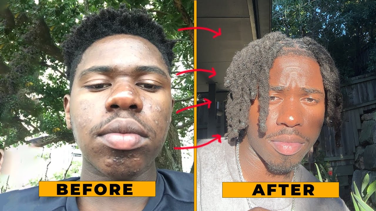 How I FINALLY Got Rid of My Acne
