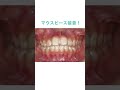 マウスピース矯正 #歯並び #歯科衛生士 #マウスピース #マウスピース矯正 #歯医者 #矯正 #矯正歯科 #インビザライン