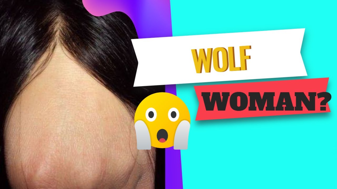 PROTESI CAPELLI 💥 Incredibile 0,02 ! Shock UNDETECTABLE HAIR SYSTEMS