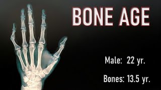 WHY GROWTH IS SOMETIMES POSSIBLE IN ADULTHOOD  (The  Bone Age Secret)
