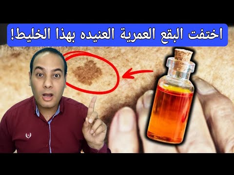 كيف تتخلص من بقع الشيخوخة للأبد علاج البقع العمرية العنيده أفضل مكمل يمسح بقع الشيخوخة بسرعه