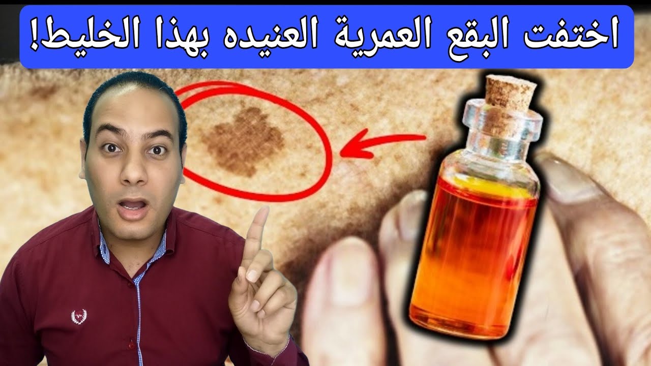 كيف تتخلص من بقع الشيخوخة للأبد/علاج البقع العمرية العنيده/أفضل مكمل يمسح بقع الشيخوخة بسرعه!