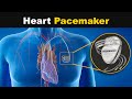 How heart pacemaker works urduhindi