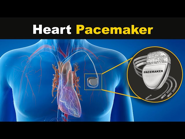 How Heart Pacemaker works? (Urdu/Hindi) class=