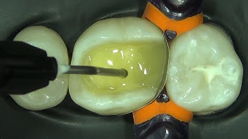 Classe II – Resina Bulk Fluida (Class II - Flowable Bulk Fill Composite)