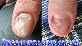 Онихолизис ногтей лечение и восстановление