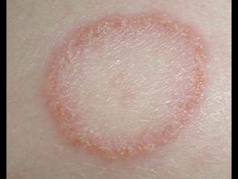 Video: 3 načina liječenja seboreičnog dermatitisa