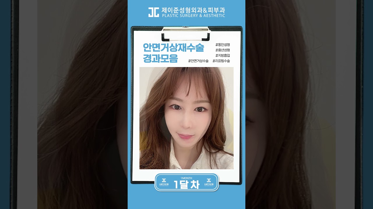 [제이준 성형외과 피부] Đường nhăn biến mất, trông trẻ trung hơn~✨ | Tổng hợp tiến trình phẫu thuật nâng cơ mặt lần 2 #shorts