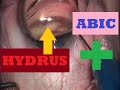 How to MIGS: ABIC + HYDRUS in Severe Glaucoma (MIGS)