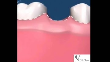 Phục hồi răng khi răng sâu hư hỏng toàn bộ thân răng, chỉ còn chân răng.