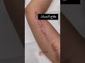 علاج الندبات 
